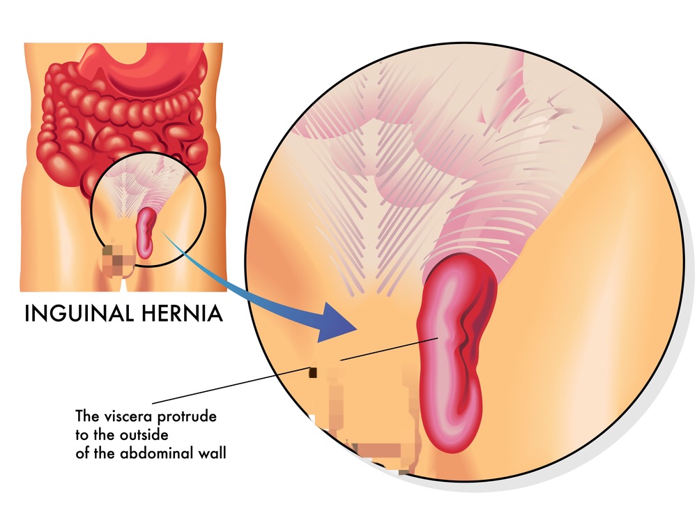 Hérnias podem voltar após a cirurgia?
